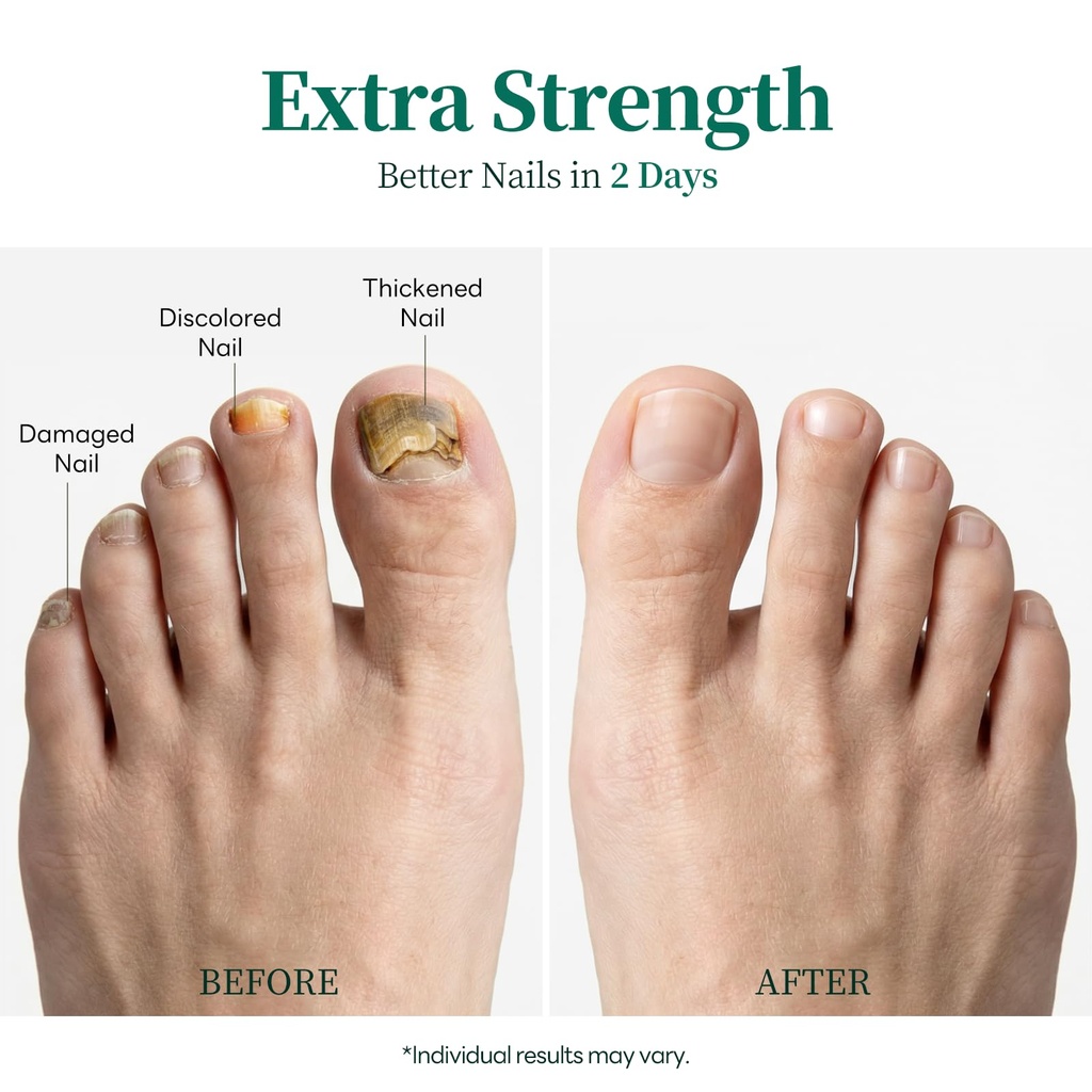 apuree-day-night-fungal-pen-extra-streng-71R6anvzIGL.jpg